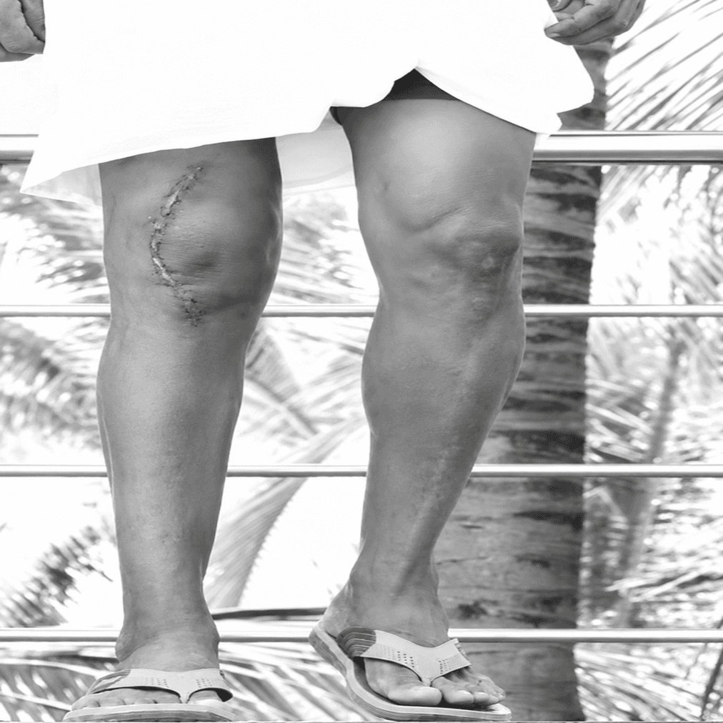 Total Knee Replacement