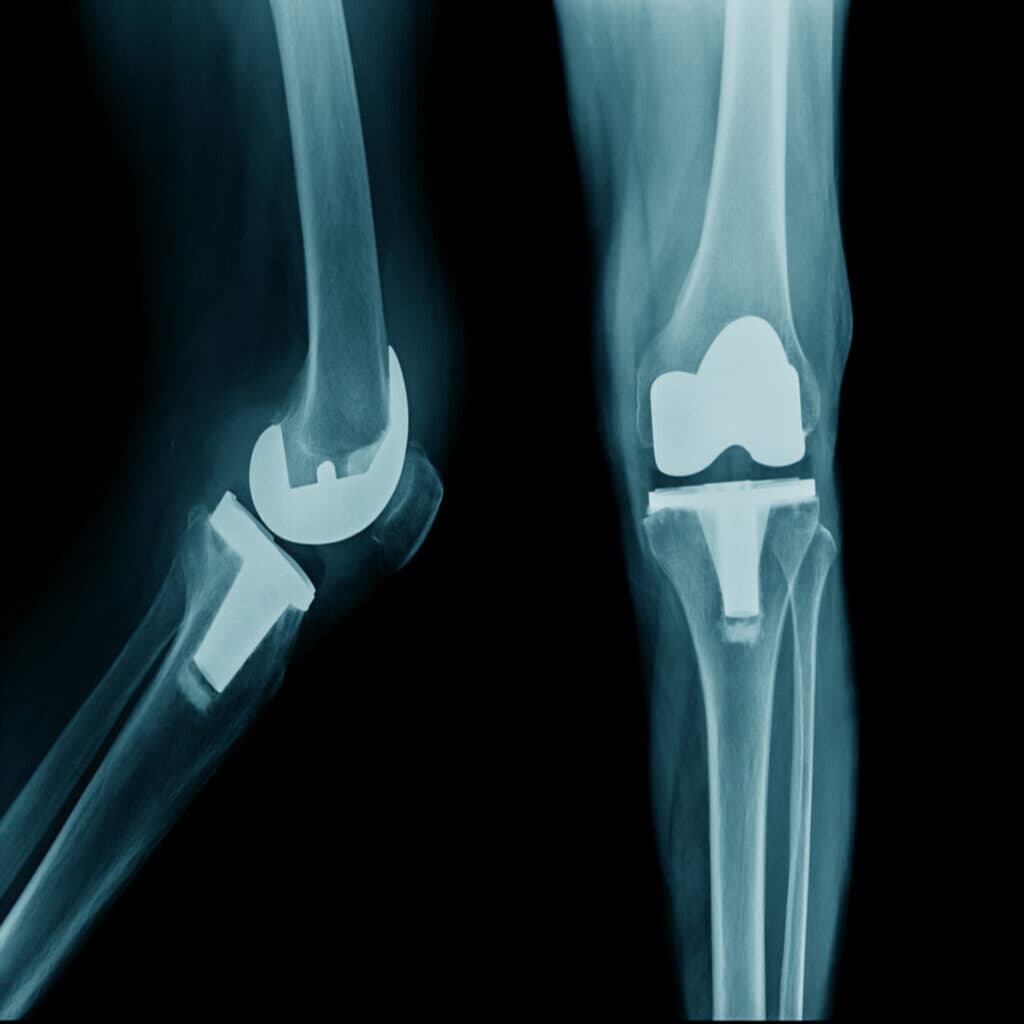 Knee Replacement Surgery