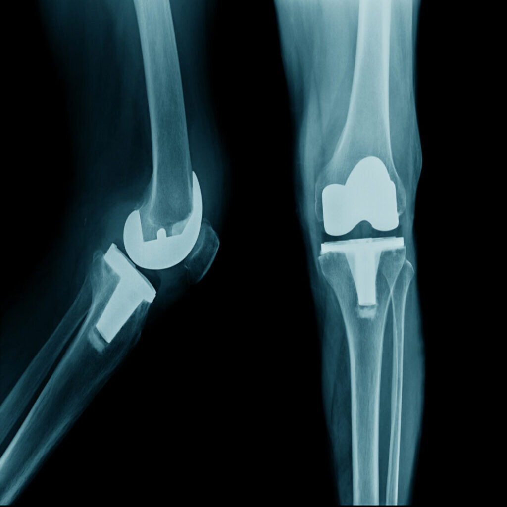 Knee Replacement Surgery